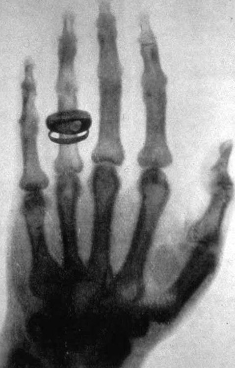 X-ray of Professor Albert von Kölliker