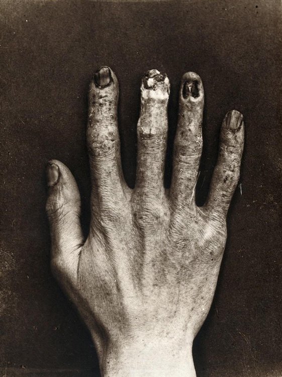Hand of Clarence Dally